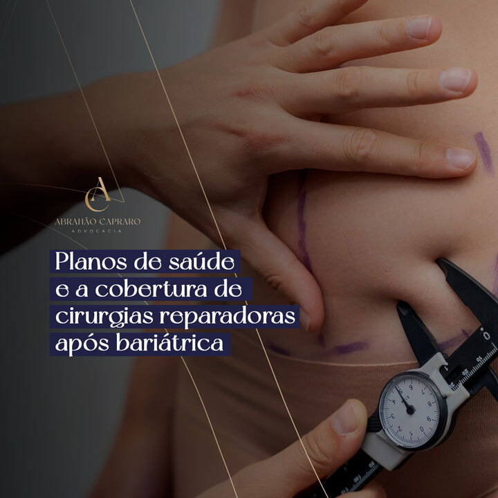 Entenda seus direitos: planos de saúde e a cobertura de cirurgias reparadoras após bariátrica